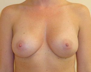 Breast Augmentation Boston