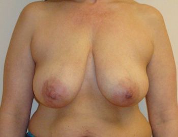 Breast Lift Before And After