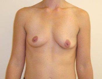 Breast Revision & Asymmetry Before And After