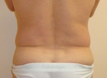 Liposuction MA before and after