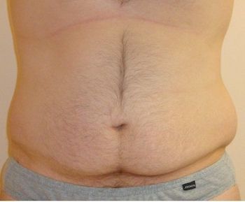 Liposuction for men boston