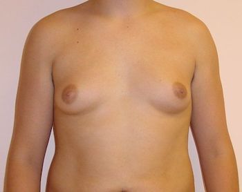 Male Breast Reduction Boston